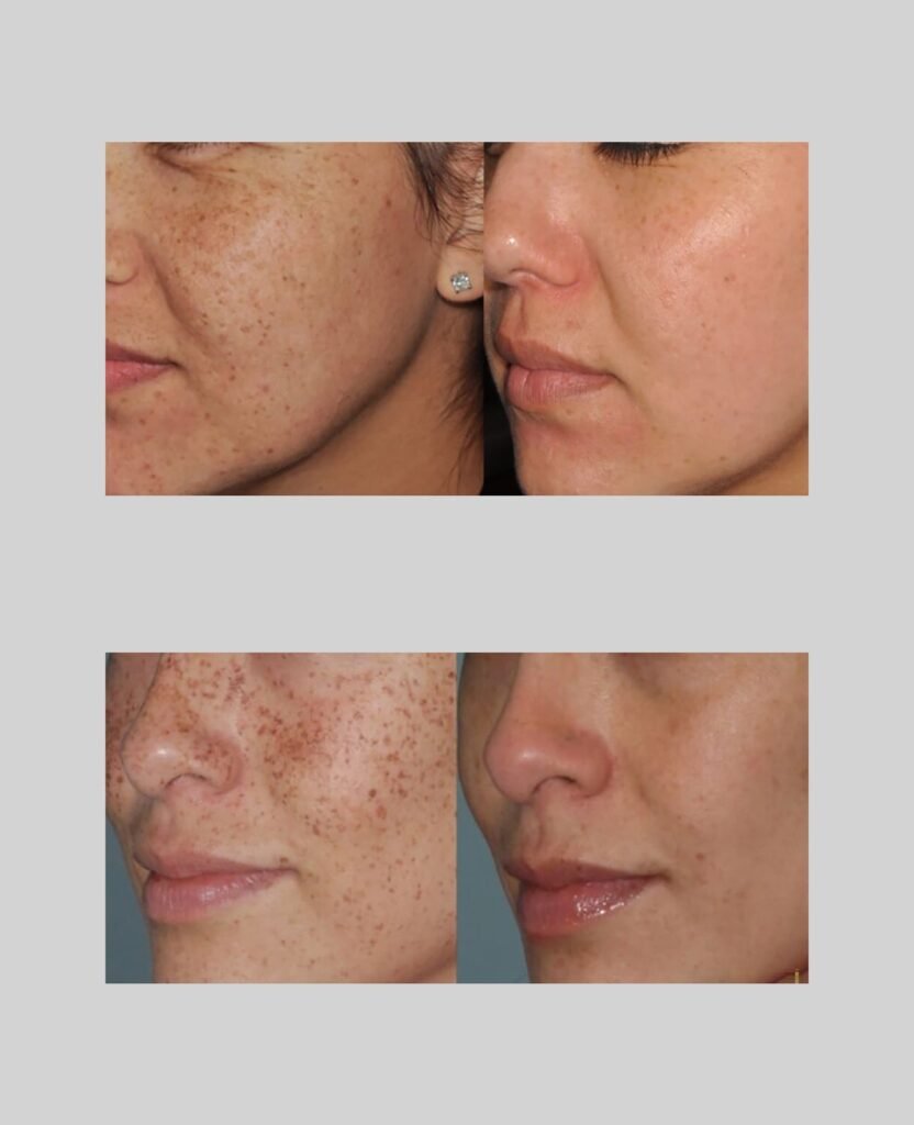 Blemish Removal before after