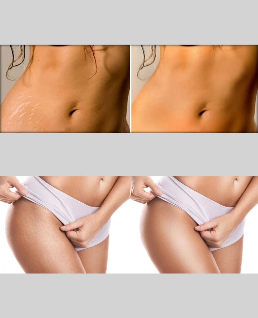 Stretch Mark Removal before after