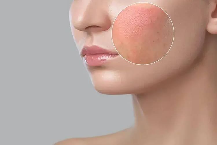 Soothing & Redness Reduction