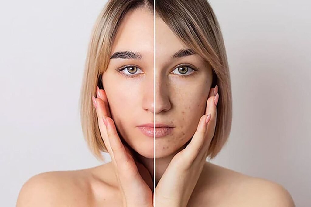 acne scars