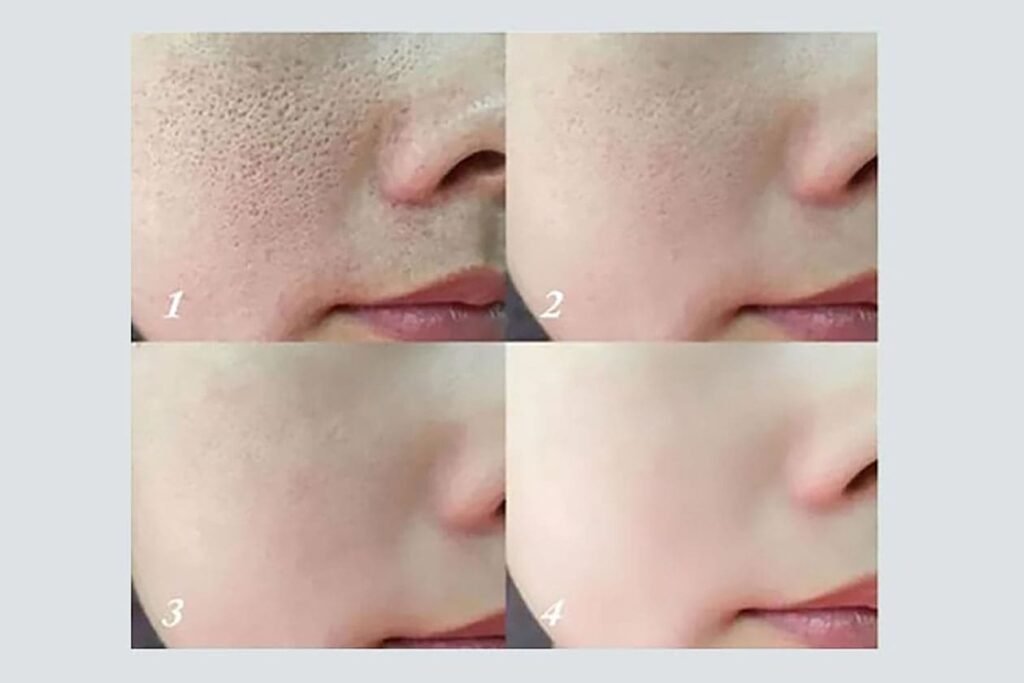 Pore Refining