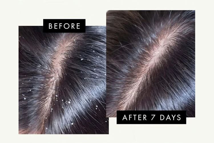 Scalp Purity & Flake Appearance