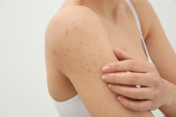Keratosis Pilaris & Rough Body Areas